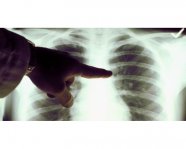欧美新研究表明：VAPE蒸汽对肺部细胞无毒副作用